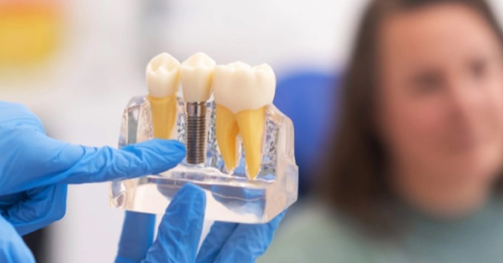 Dental Implants in Gorakhpur