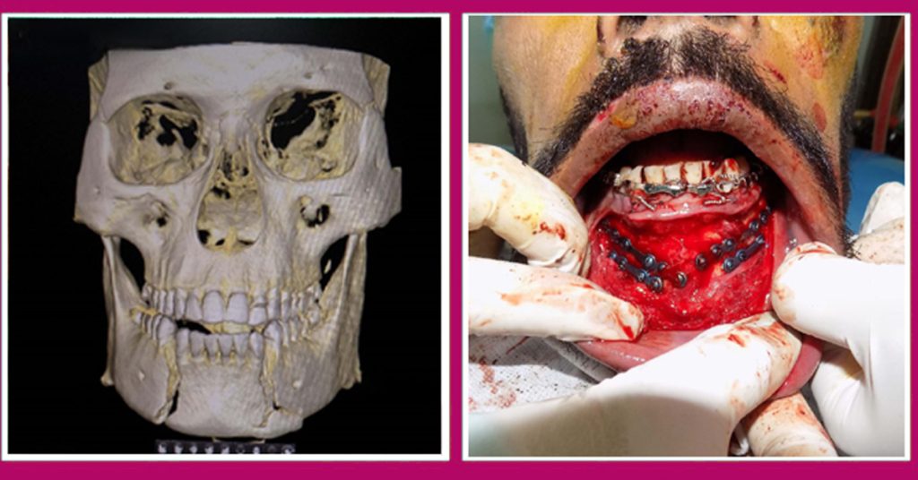 jaw fracture treatment
