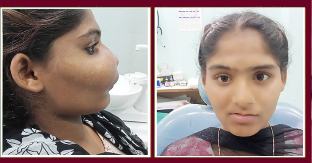 Jaw Surgery in Gorakhpur