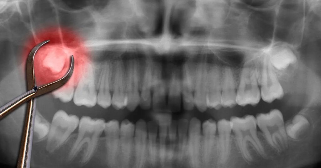 Wisdom Tooth Removal