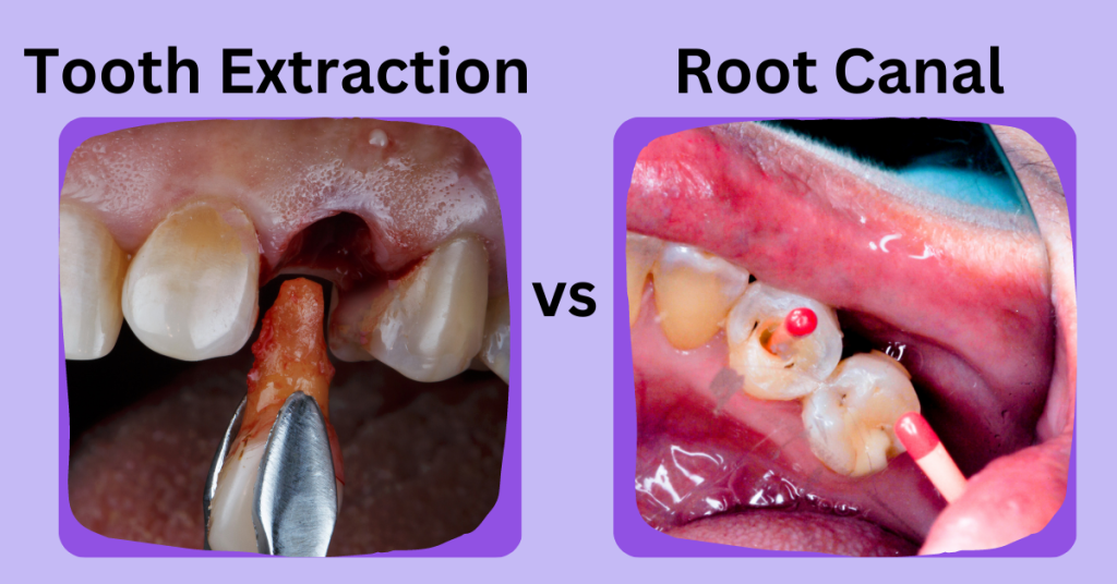 root canal