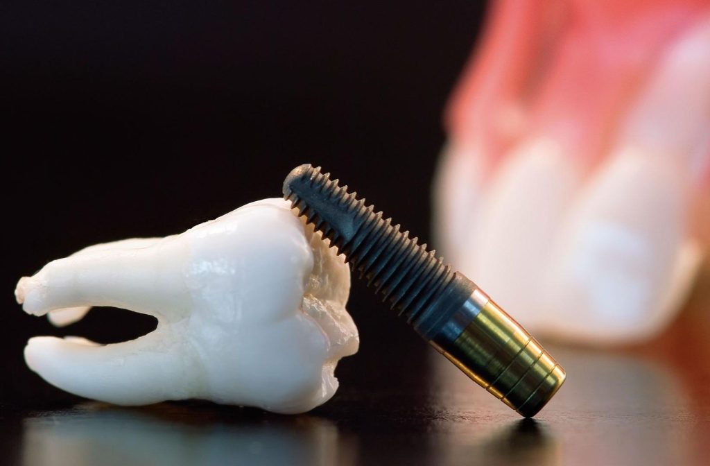 Best Dental Implants in Gorakhpur – Cost, Procedure & Recovery