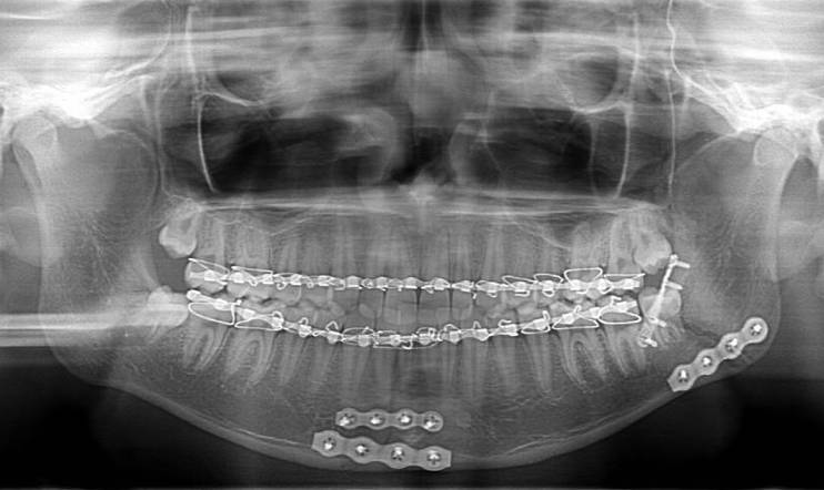 Jaw Fracture Treatment in Gorakhpur – Causes, Symptoms & Solutions