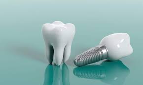 Dental Implant Cost in Gorakhpur