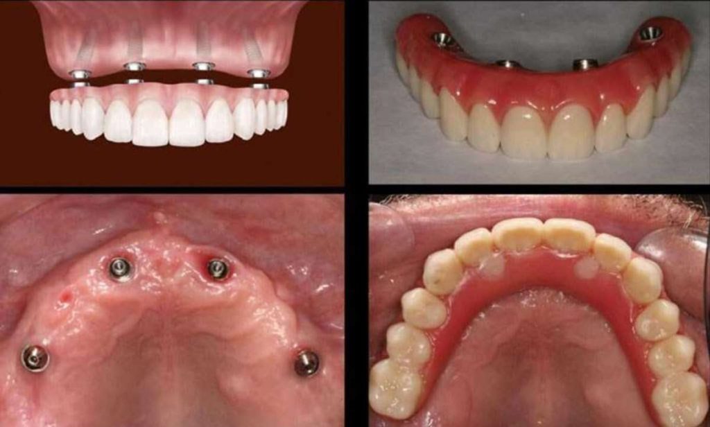 Dental Implants in Gorakhpur