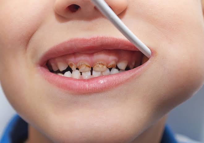 Baby Teeth Cavities