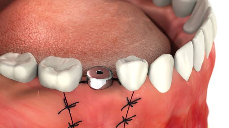Best Single Tooth Implant Gorakhpur
