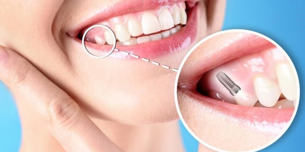 Best Implantologist in Gorakhpur