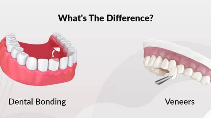 Bonding vs Veneers