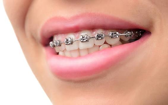 Braces for Adults