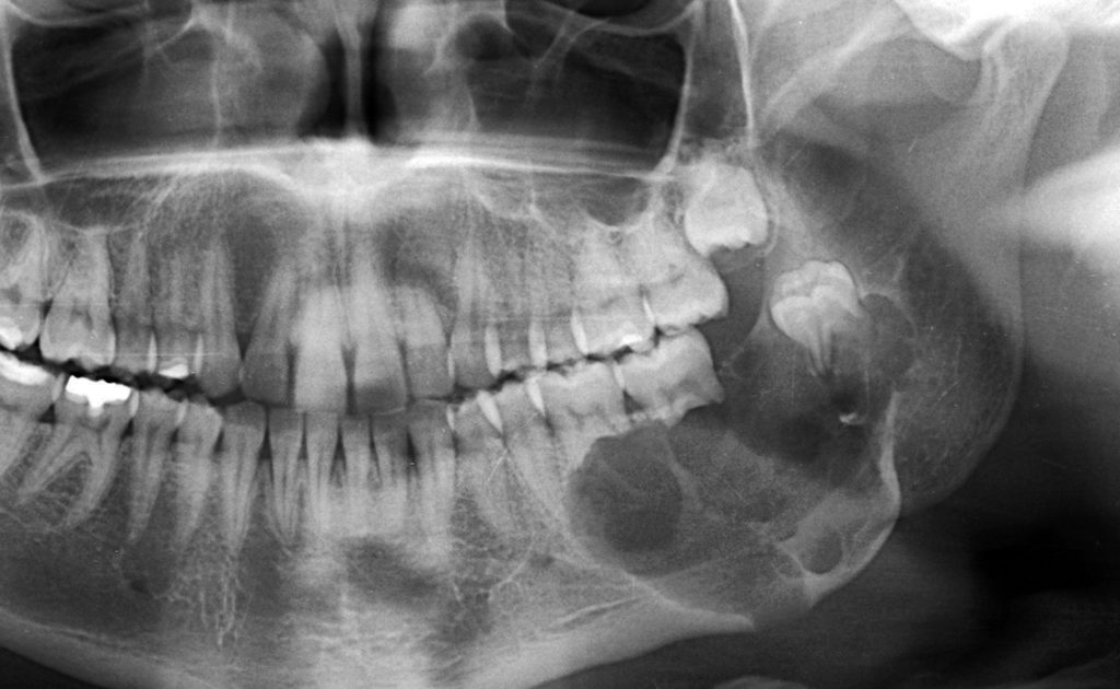 Dental Cysts and Tumors