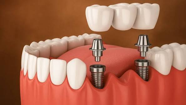 Dental Implants In Gorakhpur