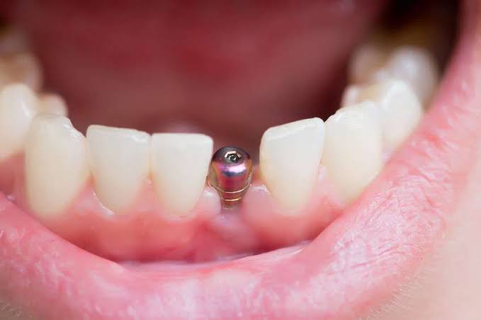 Dental Implant Recovery