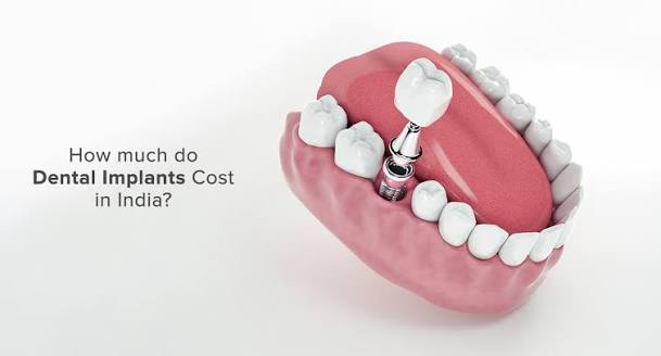 Dental Implants in Gorakhpur