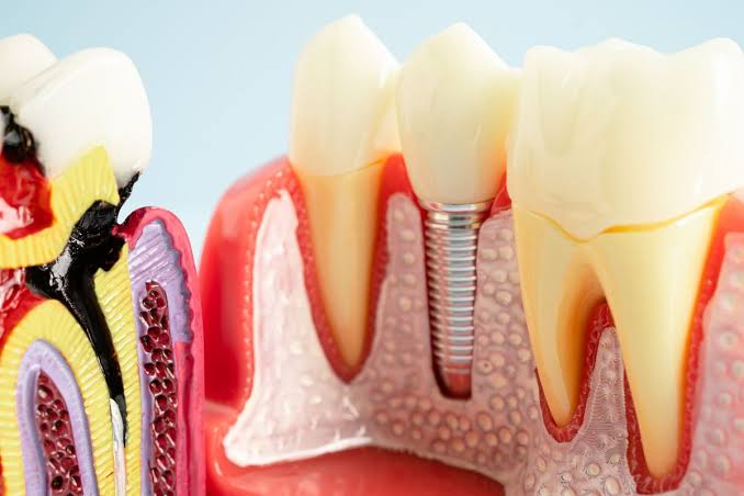Dental Implants Painful