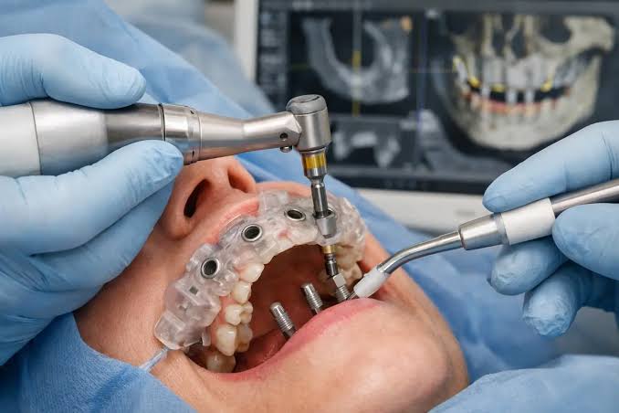 Dental Implants in Gorakhpur