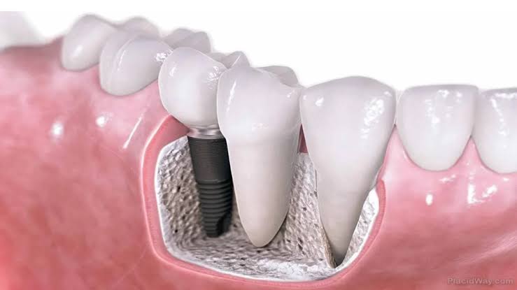 Dental Implants