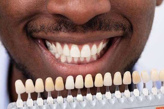 Dental Veneers in Gorakhpur