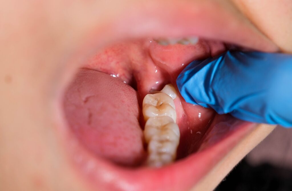 Wisdom Teeth