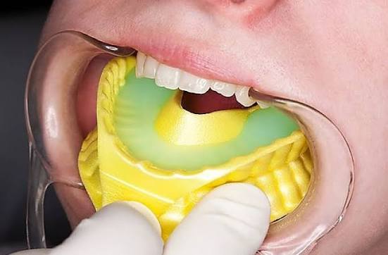 Fluoride Treatment for Children