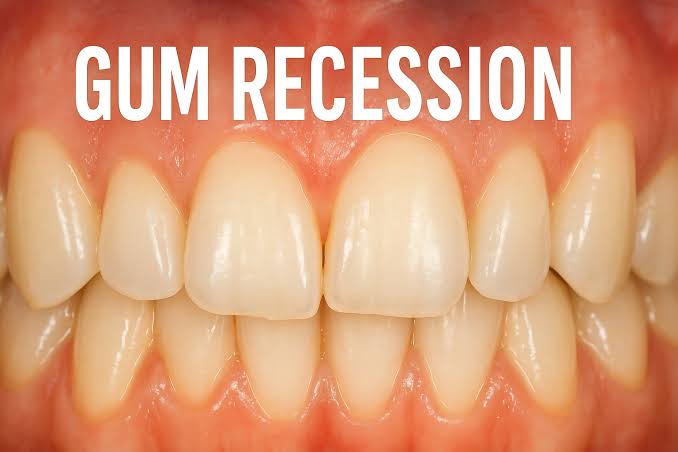 Gum Recession