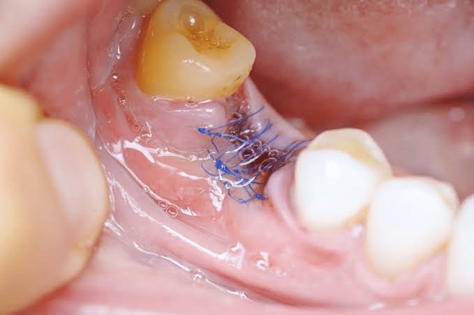 Impacted Tooth Surgery