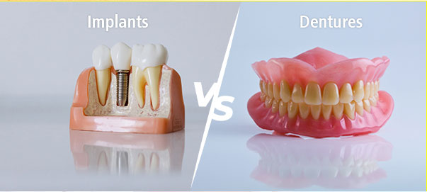Implants vs Dentures