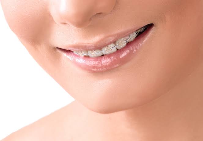 Invisible Braces