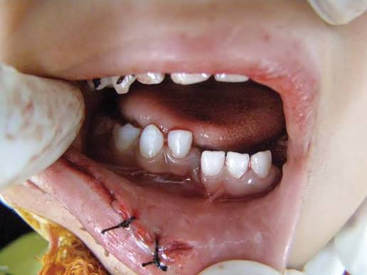Jaw Fracture Treatment