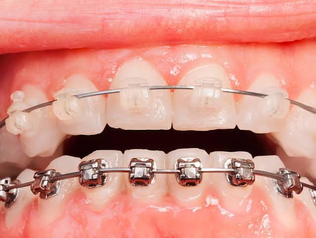 Metal vs Ceramic Braces