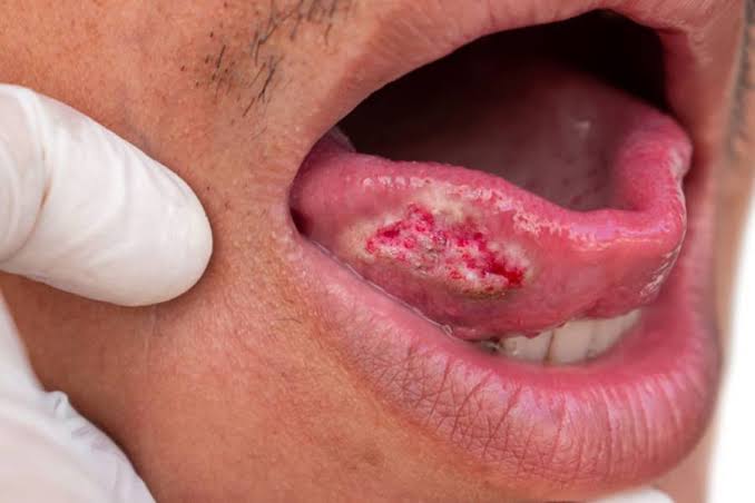 Mouth Cancer Treatment