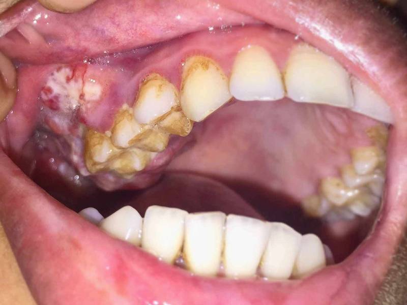 Oral Cancer Specialist in Gorakhpur