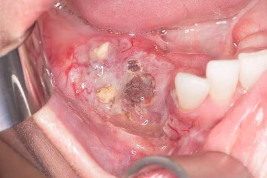 Oral Cancer