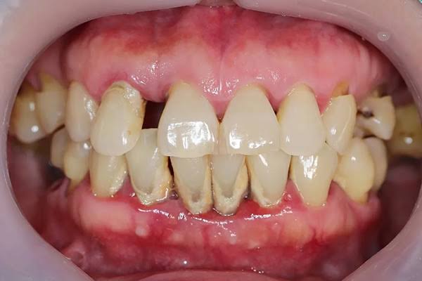 Periodontitis