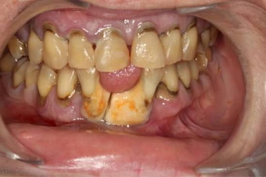 Pyorrhea Treatment
