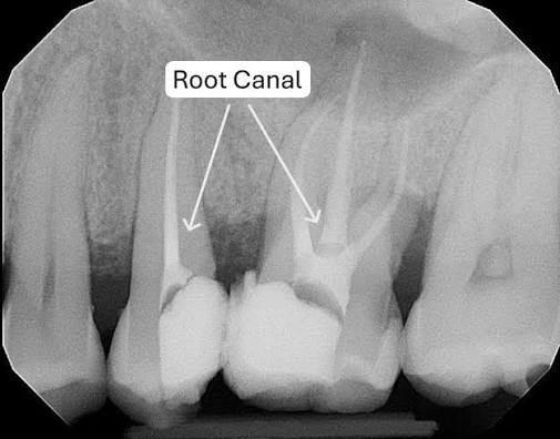 Root Canal