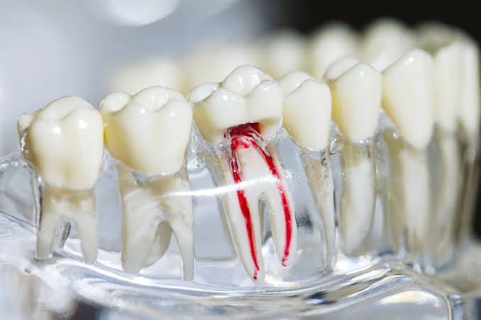 Root Canal Retreatment