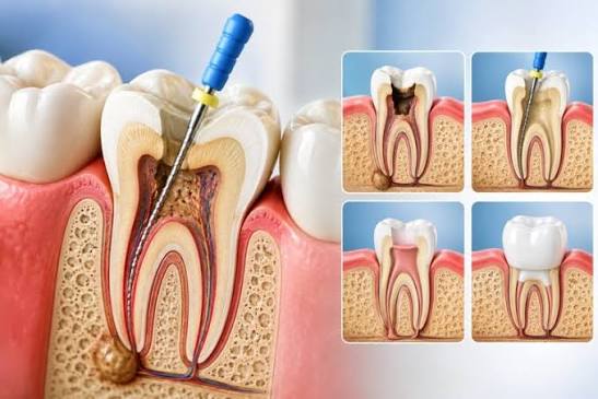 Root Canal Treatment