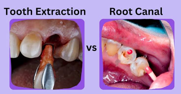 Root Canal vs Tooth Extraction