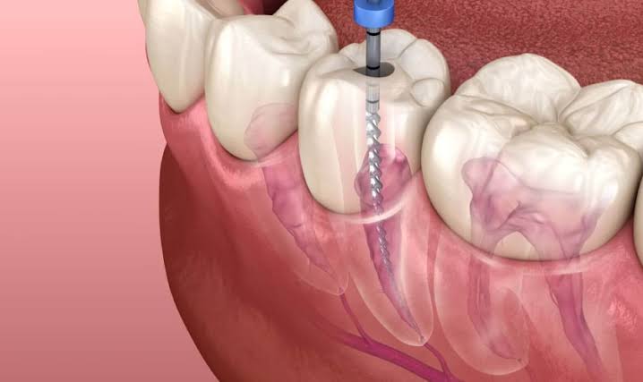 Root Canals