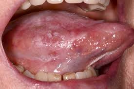 Signs of Oral Cancer