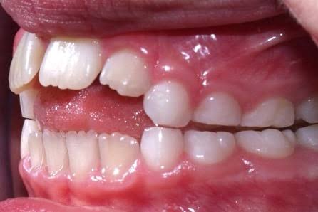 Thumb Sucking and Its Effect on Teeth