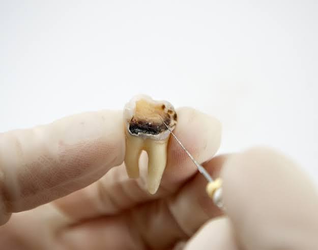 Wisdom Tooth Extraction