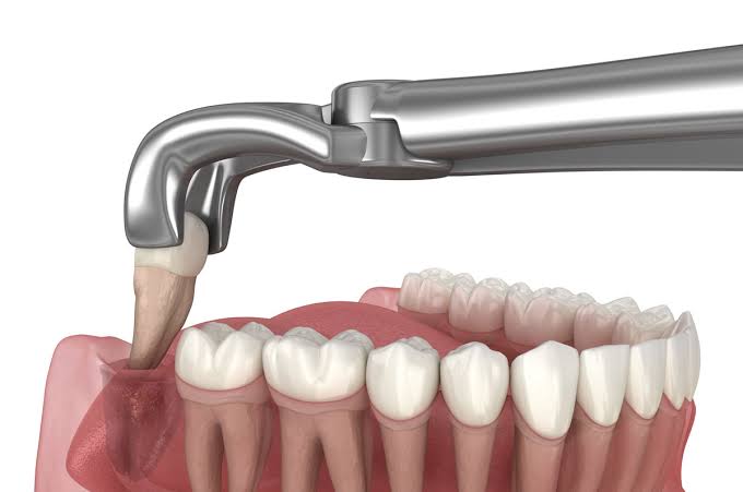 Wisdom Tooth Surgery