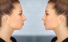Genioplasty