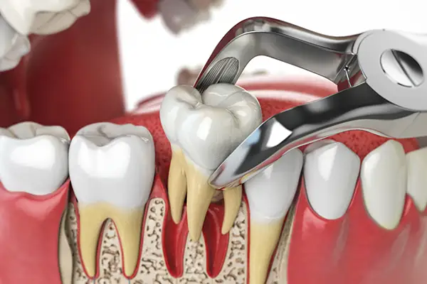 Tooth Extraction