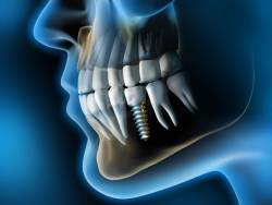 Dental Implants