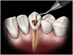 Root Canal Treatment (RCT)