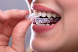 Invisible Aligners