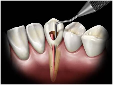 Root Canal Treatment (RCT)